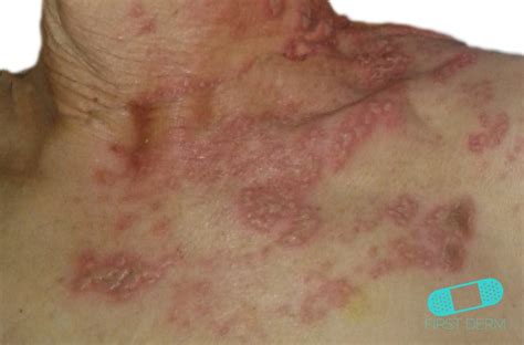 kulibrang tubig|Global Dermatology » Kulebra (Shingles; Herpes Zoster).